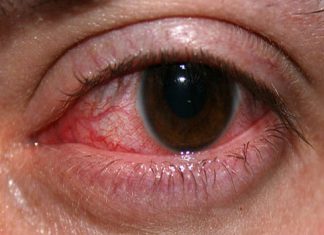 رابطه کبدچرب و دیابت با خونریزی چشمی و عوارض آن