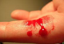 چگونه جلو خونریزی را بگیریم؟